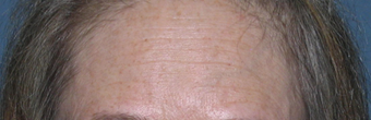 Before & After Fraxel Laser before 1064720