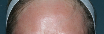 Before & After Fraxel Laser after 1064720