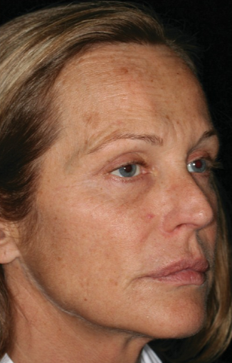 45-54 year old woman treated with Laser Resurfacing before 1860036