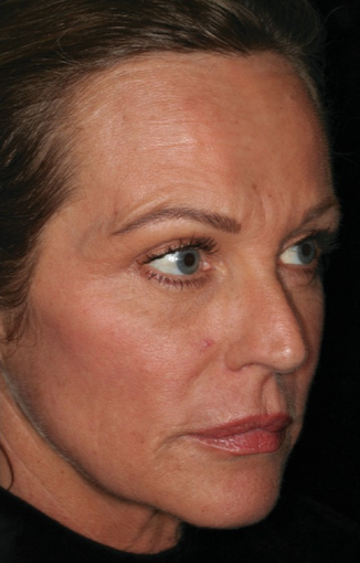45-54 year old woman treated with Laser Resurfacing after 1860036