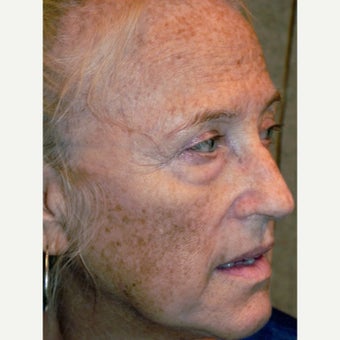 64 year old woman treated with RESET Laser Skin Resurfacing and lower lid blepharoplasty before 1941532