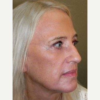 64 year old woman treated with RESET Laser Skin Resurfacing and lower lid blepharoplasty after 1941532