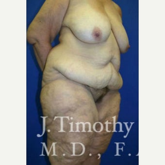 Body Lift 1652529
