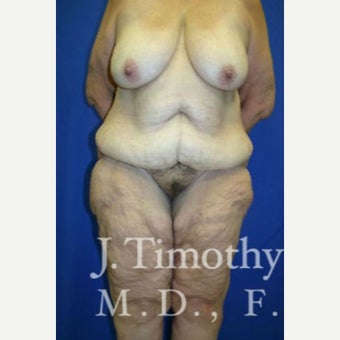 Body Lift before 1652529