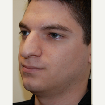 25-34 year old man treated with Rhinoplasty before 3792781