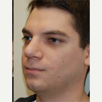 25-34 year old man treated with Rhinoplasty after 3792781