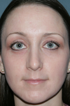 Fraxel Repair for Acne Treatment after 1064635