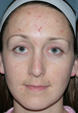 Fraxel Repair for Acne Treatment before 1064635