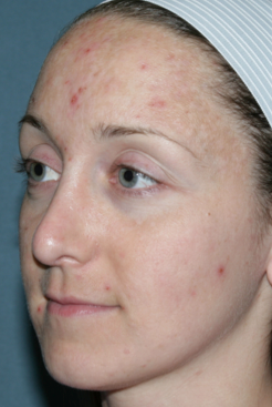 Fraxel Repair for Acne Treatment 1064635