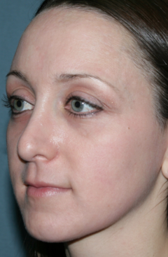 Fraxel Repair for Acne Treatment 1064635