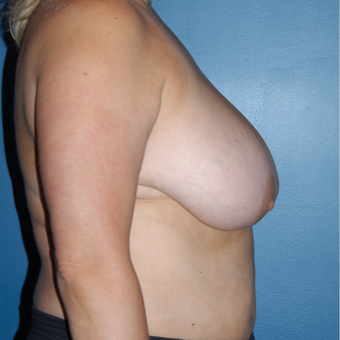 45-54 year old woman treated with Breast Reduction before 3814111