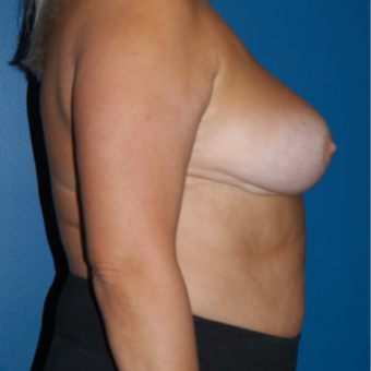 45-54 year old woman treated with Breast Reduction after 3814111
