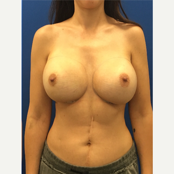 35-44 year old woman treated with Breast Implant Revision after 3475828