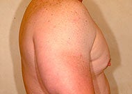 Liposuction for Gynecomastia before 74775
