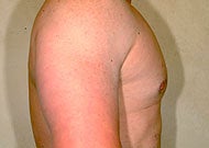 Liposuction for Gynecomastia after 74775