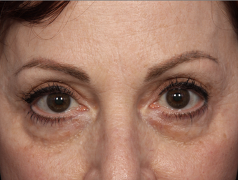 Restylane before 302234
