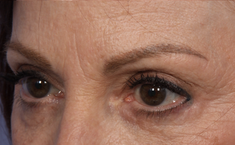 Restylane 302234