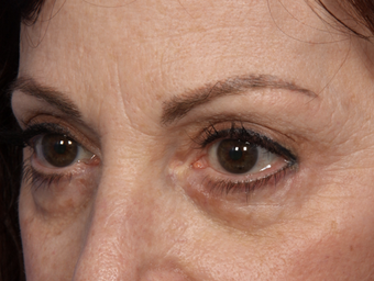 Restylane 302234