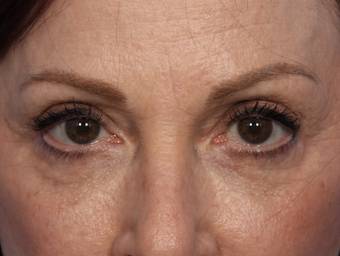 Restylane after 302234