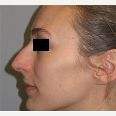18-24 year old woman treated with Nose Surgery before 3503101