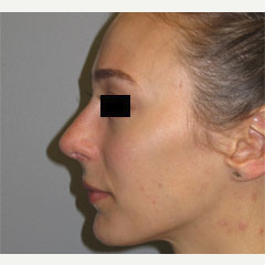 18-24 year old woman treated with Nose Surgery after 3503101