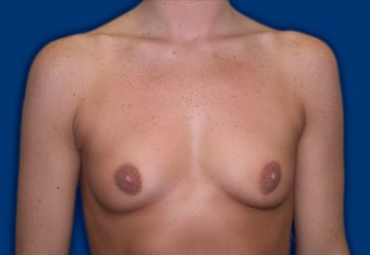 Breast Augmentation before 611063