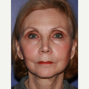67 year old woman treated with Facelift after 3710703