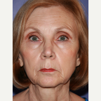 67 year old woman treated with Facelift before 3710703