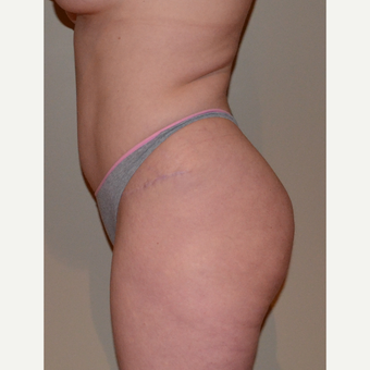 35-44 year old woman treated with Brazilian Butt Lift Revision before 2941005