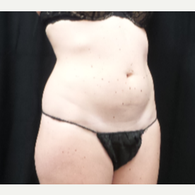 25-34 year old woman treated with truSculpt before 3424081