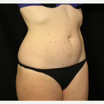 25-34 year old woman treated with truSculpt after 3424081