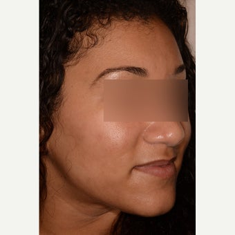 Acne treatment after 1747113
