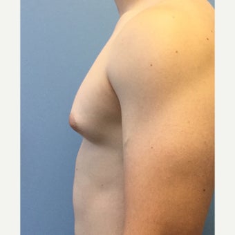 18-24 year old man treated with Male Breast Reduction before 2303802