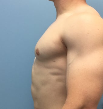 18-24 year old man treated with Male Breast Reduction after 2303802