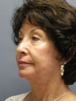 65-74 year old woman treated with Neck Lift before 3103884