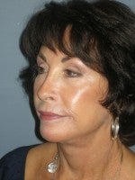 65-74 year old woman treated with Neck Lift after 3103884