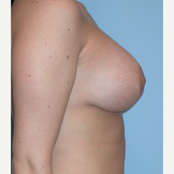 18-24 year old woman treated with Breast Lift after 3076192
