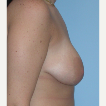 18-24 year old woman treated with Breast Lift before 3076192