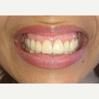 40 year old woman treated with Porcelain Veneer and Bridge and Gum Lifting after 3854226