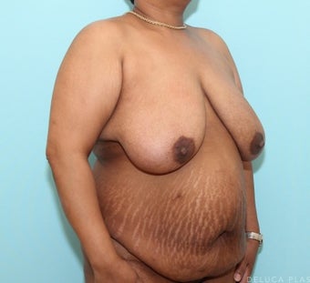 Mommy Makeover with Breast Reduction and Abdominoplasty before 3480802