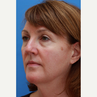 Woman treated with Revision Facelift and Fat Grafting before 3104757