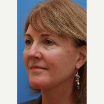 Woman treated with Revision Facelift and Fat Grafting after 3104757