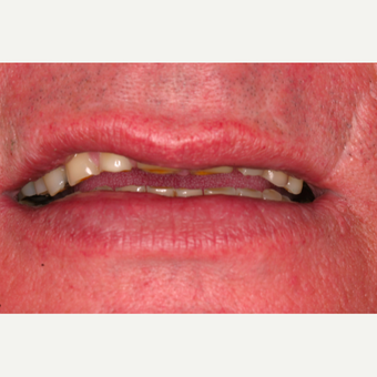 62 year old male with worn dentition treated with smile makeover procedures before 3395054