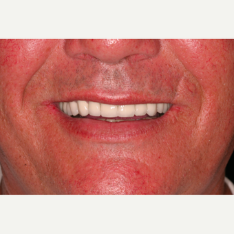 62 year old male with worn dentition treated with smile makeover procedures after 3395054