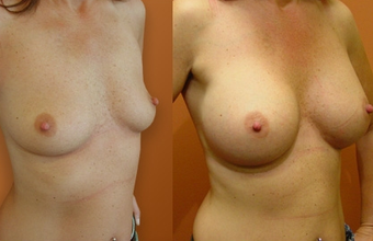Breast Implants before 974252