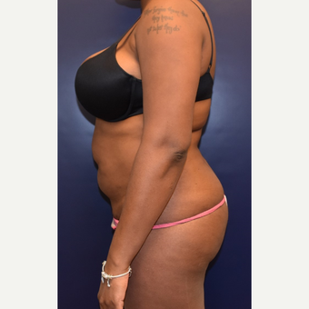 25-34 year old woman treated with Brazilian Butt Lift before 3344243