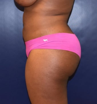25-34 year old woman treated with Brazilian Butt Lift after 3344243