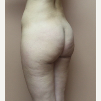25-34 year old woman treated with Brazilian Butt Lift before 3458325
