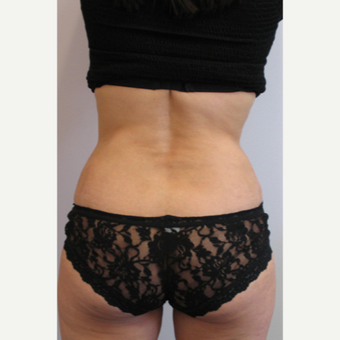 Back Liposuction with abdominoplasty after 3753981
