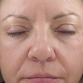 35-44 year old woman treated with Glycolic Peel after 2005153